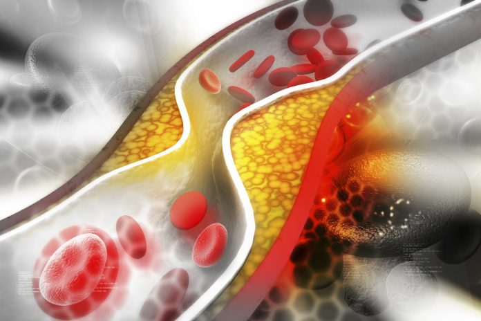 Cholesterol plaque in artery